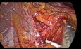 Vólvulo Gástrico, Tratamiento Laparoscópico