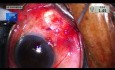 Derivación de glaucoma con inyección de esteroides para uveítis