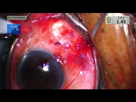Derivación de glaucoma con inyección de esteroides para uveítis