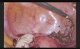 Laparoscopia de endometriosis - el uso de iluminación infrarroja