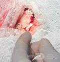 Estirpación de cavernoma subcortical 
