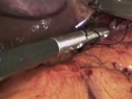 Laparoscopia de la hernia hiatal con cirugía bariátrica
