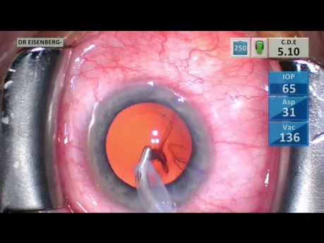 Chirurgie de la Cataracte avec Glaucoma Microstent - Édition didactique sans coupures