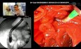 CPRE: SEMS en el cáncer de páncreas avanzado