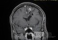 Estirpación de cavernoma subcortical 