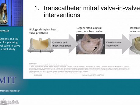 Tomografía computarizada y simulación de modelos 3D para planificar intervenciones transcatéter de válvula mitral (valve-in-valve): un estudio piloto