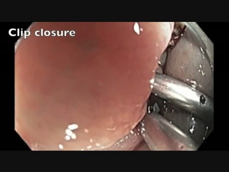 Perforación del colon tras RME - H