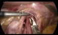 Cardiomiotomía de Heller laparoscópica