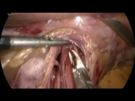 Cardiomiotomía de Heller laparoscópica