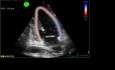 Sobrecarga del corazón en ecocardiografía