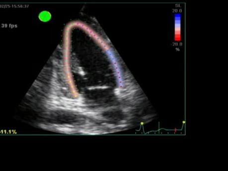 Sobrecarga del corazón en ecocardiografía