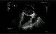 Endocarditis infecciosa de la válvula mitral