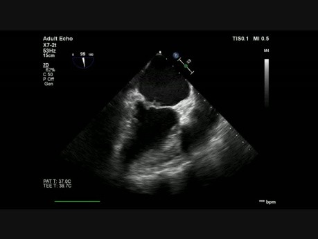 Endocarditis infecciosa de la válvula mitral