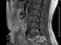 Microdiscectomía Lumbar
