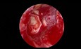 Timpanoplastia endoscópica con cartílago en mariposa para perforación timpánica
