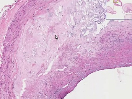 Ateroesclerosis - examen histopatológico - arterias coronarias