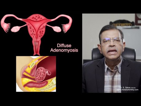 Fibromas y adenomiosis - ¿qué es la diferencia?