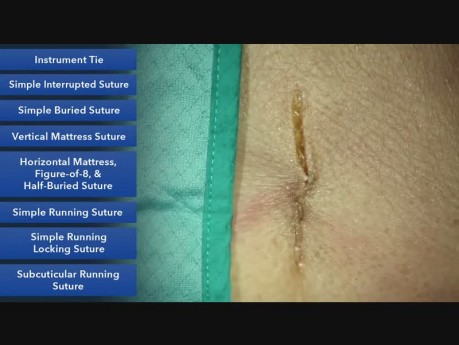 Sutura subcuticular continua - técnicas de sutura