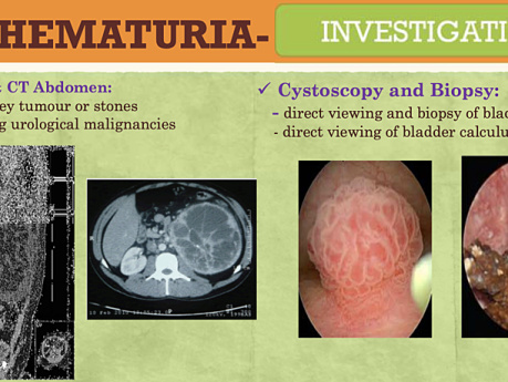 Urología / Hematuria / Cólico renal y ureteral / Obstrucción de la salida de la vejiga