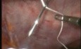 Reparación laparoscópica de hernia ventral