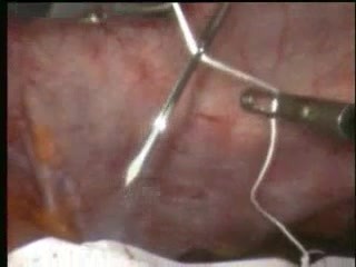 Reparación laparoscópica de hernia ventral