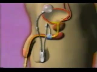 Esfínter urinario artificial - Animación