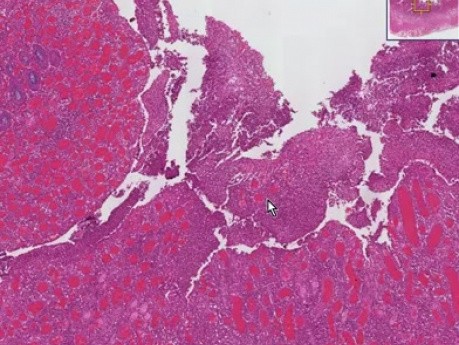 Enfermedad de Crohn - histopatología - intestino delgado