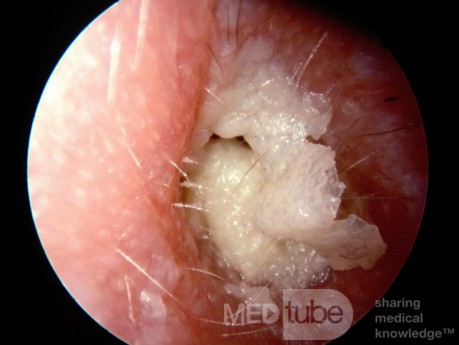 Otitis externa crónica con grandes láminas blancas de queratina