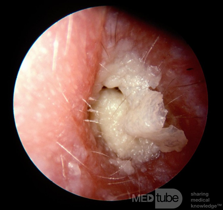Otitis externa crónica con grandes láminas blancas de queratina