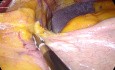 Mini bypass gástrico laparoscópico