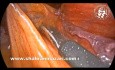 Reducción del saco (puente) durante la herniorrafia laparoscópica