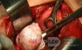 Arrenoblastoma 