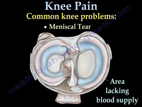 Causas comunes de dolor de rodilla