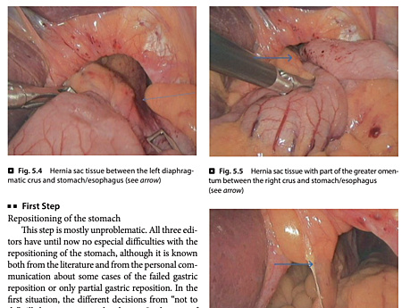 Operaciones Gastrointestinales y Variaciones Técnicas