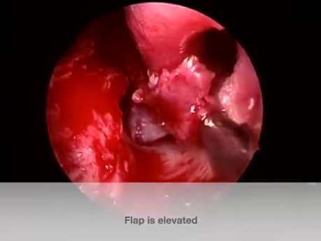 Reparación endoscópica de perforación del tabique nasal