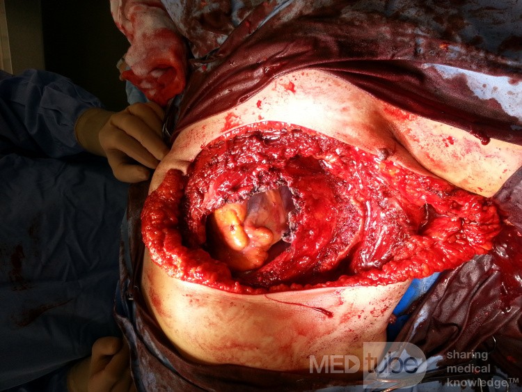 El defecto en la pared torácica y el pericardio intactos después de la extirpación del liposarcoma de la mama izquierda