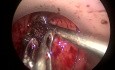 Tratamiento transanal (TAMIS) de fístula rectovesical tras resección anterior baja por cáncer de recto