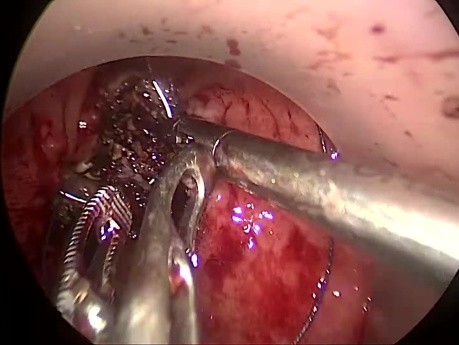 Tratamiento transanal (TAMIS) de fístula rectovesical tras resección anterior baja por cáncer de recto