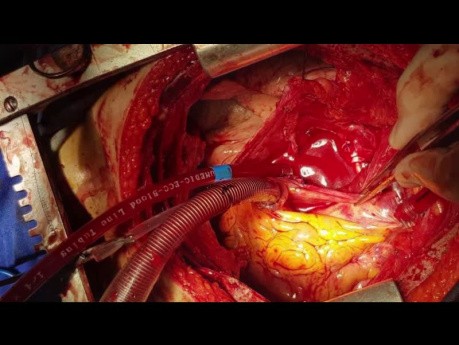 Sarcoma bilateral de la arteria pulmonar