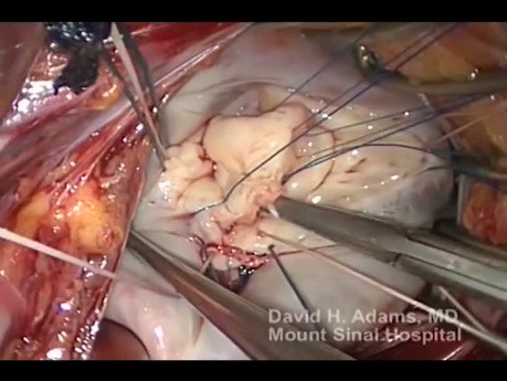 Reparación de la válvula mitral por deficiencia fibroelástica con prolapso del velo posterior
