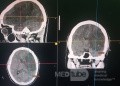 Craniectomía descompresiva en infarto maligno de la arteria cerebral media