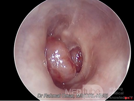 Pólipo del oído medio