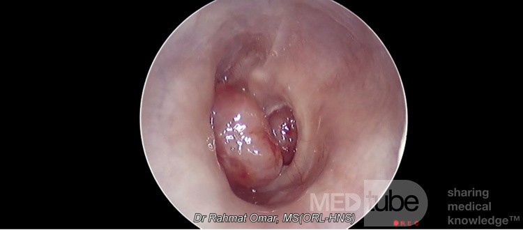 Pólipo del oído medio