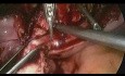 Reparación laparoscópica de istmocele