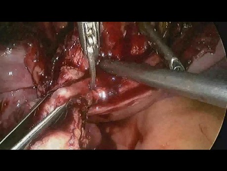 Reparación laparoscópica de istmocele