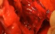 Histerectomía radical, resección del ligamento vesico-uterino