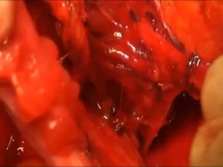 Histerectomía radical, resección del ligamento vesico-uterino
