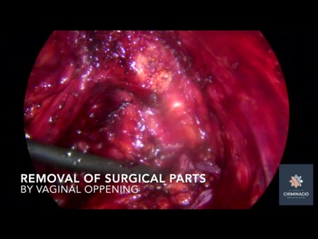 Endometriosis de útero/vejiga y nódulo en el nervio obturador izquierdo 