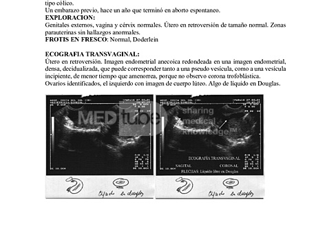 Gestacion Inicial Normal Ecografia Aumento Beha HCG en 48 Horas