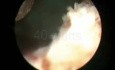 Greenlight HPS Prostatectomy - Part 2